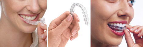 invisalign-img1