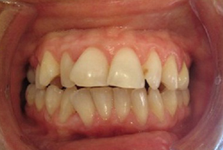 Orthodontics in London Before