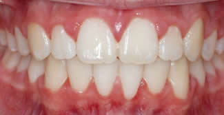 After Ceramic Braces