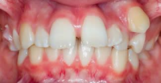 Before Ceramic Braces