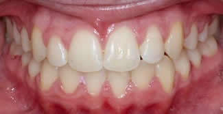 After Orthodontist Treatments in London