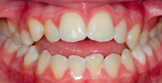 Before Orthodontist Treatments in London