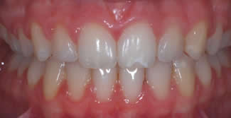 After Ceramic Braces in London