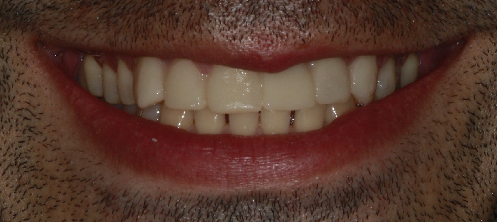 Dental Implants Crown After