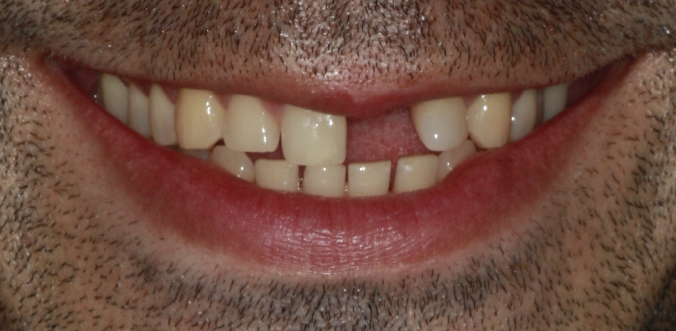 Dental Implants Crown Before