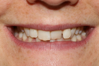 Teeth Before Inman Aligners 