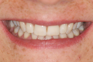 Teeth After Inman Aligners 