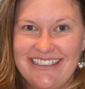 Tooth Whitening After