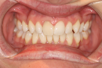 Tooth Whitening Treatment After