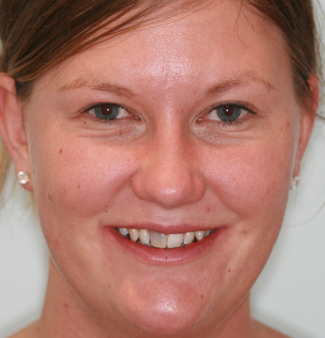 Tooth Whitening Before